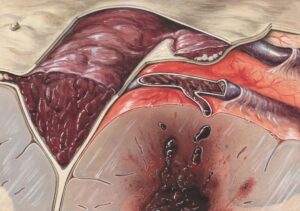 Illustration showing cross-section of blood vessels illustrating peripheral artery disease with blockages.